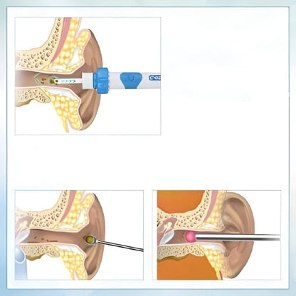 Aspirador de cera para los oídos Ear Cleaner